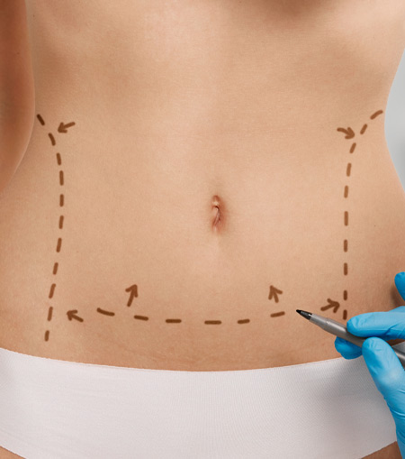 Abdominoplasty