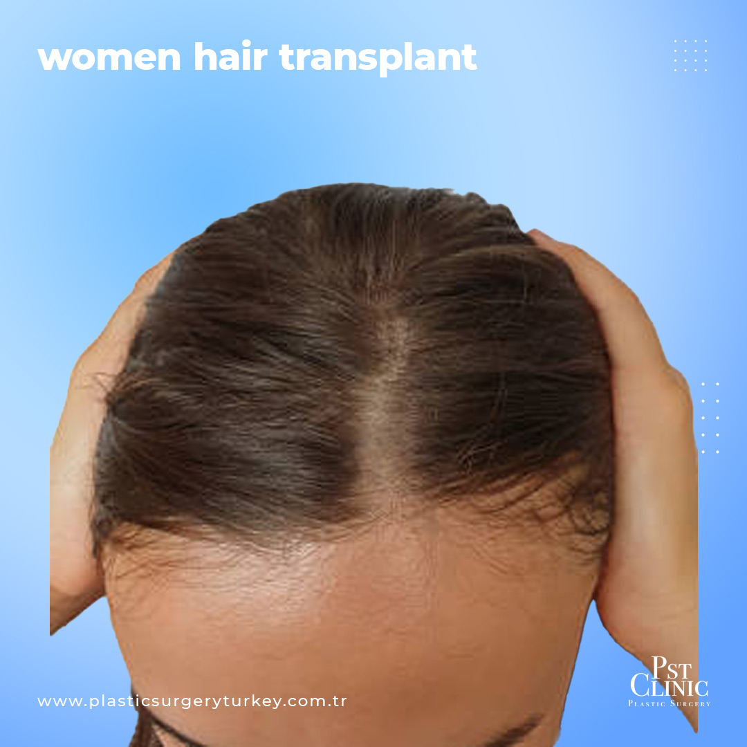 Female hair transplant turkey  Hair transplant Clinic in Turkey