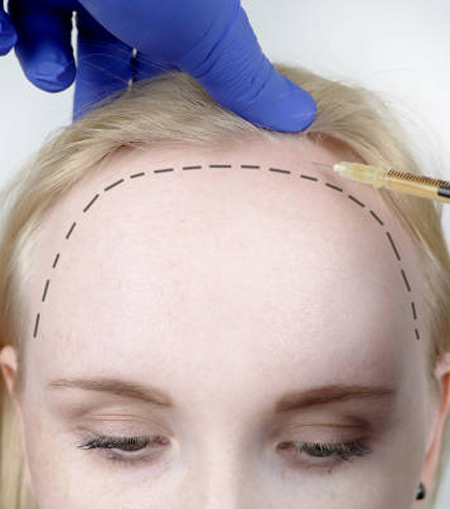 Women hair transplant